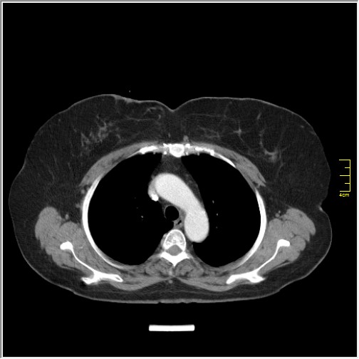 File:Breast cancer on thorax CT (Radiopaedia 60571-68275 A 30).JPG