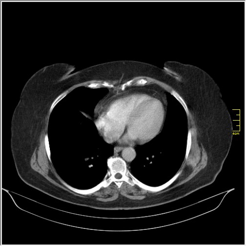File:Breast cancer on thorax CT (Radiopaedia 60571-68275 A 72).JPG