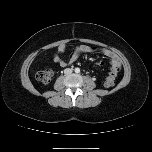 File:Breast cancer pseudocirrhosis after chemotherapy (Radiopaedia 65407-74456 A 50).jpg