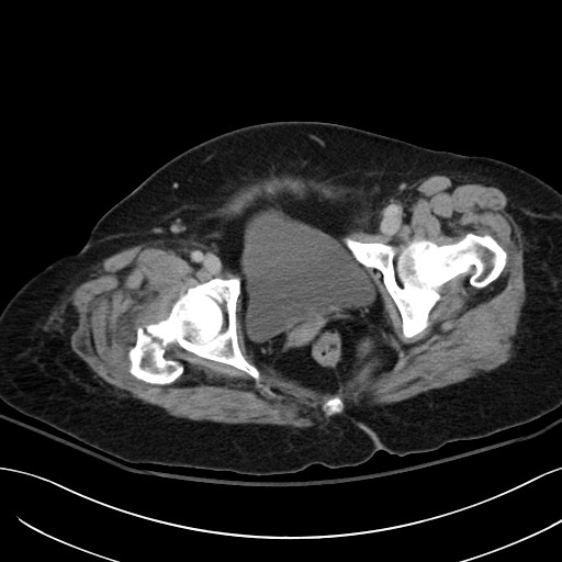 Breast carcinoma with pathological hip fracture (Radiopaedia 60314-67974 B 69).jpg