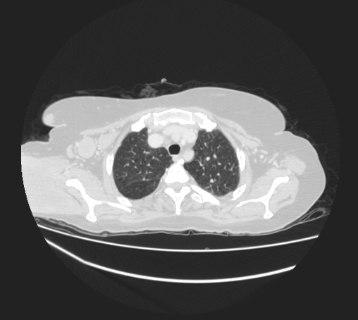 Breast metastases from facial malignant melanoma (Radiopaedia 60316-67975 Axial lung window 16).jpg