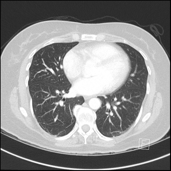 Breast metastases from renal cell cancer (Radiopaedia 79220-92225 Axial lung window 52).jpg