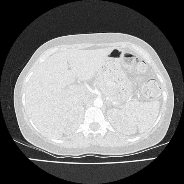 Bronchial atresia (Radiopaedia 22965-22992 Axial lung window 2).jpg