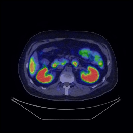 Bronchial carcinoid tumor (Radiopaedia 67377-76765 68Ga-DOTATATE PET-CT 48).jpg
