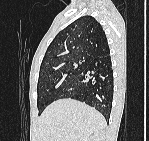 Bronchiolitis obliterans (Radiopaedia 71538-81897 Sagittal lung window 16).jpg