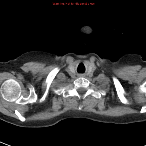 File:Bronchoalveolar carcinoma (BAC) (Radiopaedia 13436-13392 Axial non-contrast 1).jpg