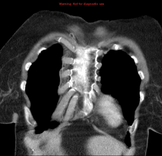 Bronchoalveolar carcinoma (BAC) (Radiopaedia 13436-13392 E 9).jpg