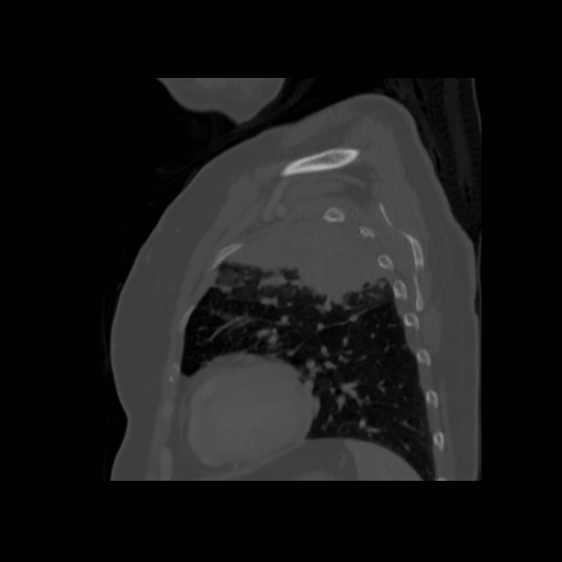 Bronchogenic carcinoma (Radiopaedia 73497-84262 Sagittal bone window 117).jpg