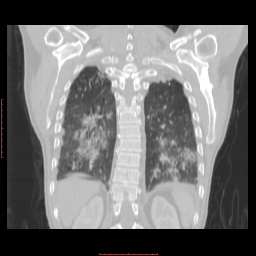 File:Bronchogenic carcinoma with left atrial large deposit - T4N3M1a (Radiopaedia 42316-45428 Coronal lung window 14).jpg