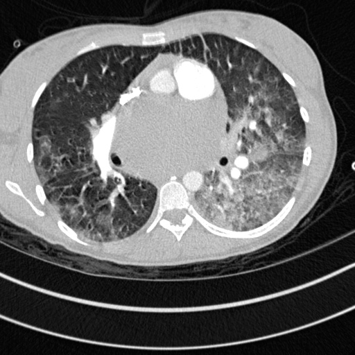 Bronchogenic cyst (Radiopaedia 77801-90071 Axial lung window 34).jpg
