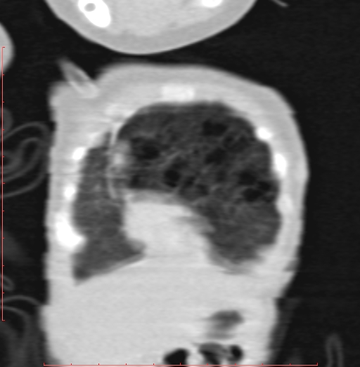 Bronchogenic cyst (Radiopaedia 78599-91409 Coronal lung window 33).jpg