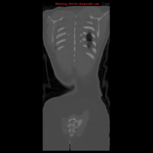 File:Brown tumor (Radiopaedia 12318-12596 D 60).jpg