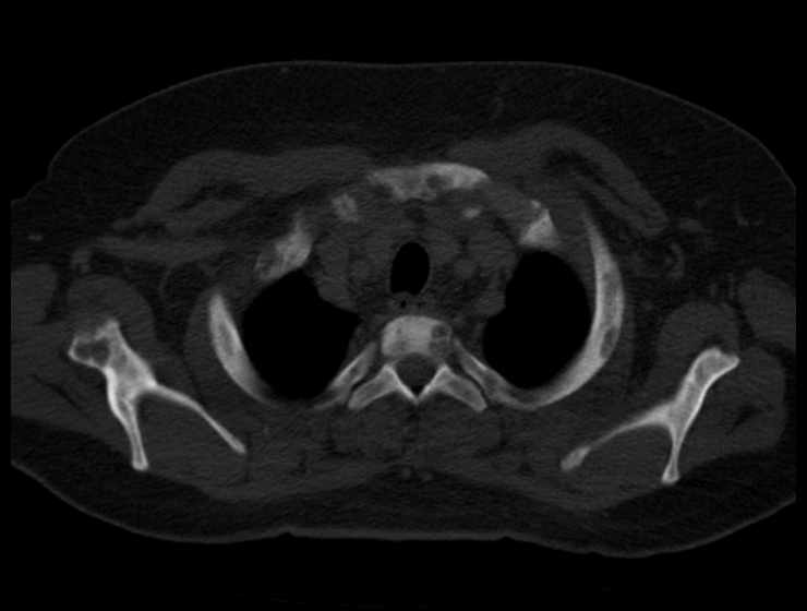 Brown tumors compressing the spinal cord (Radiopaedia 68442-77988 Axial bone window 10).jpg