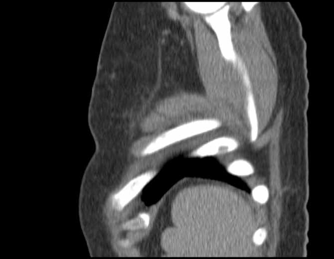 Brown tumors compressing the spinal cord (Radiopaedia 68442-77988 B 53).jpg