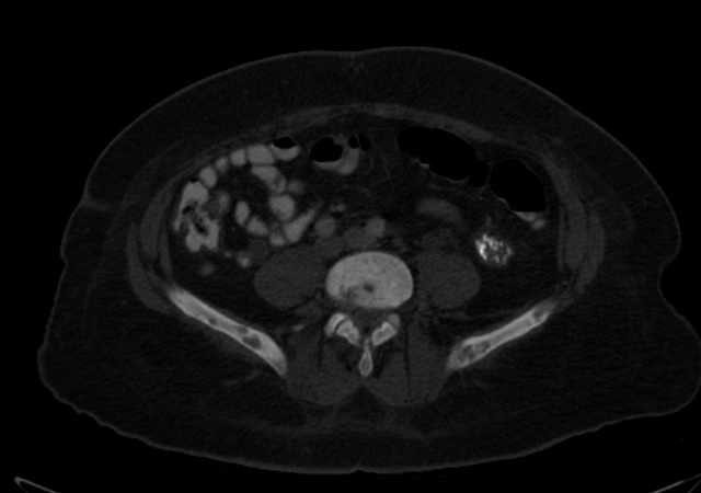 Brown tumors compressing the spinal cord (Radiopaedia 68442-77988 G 81).jpg