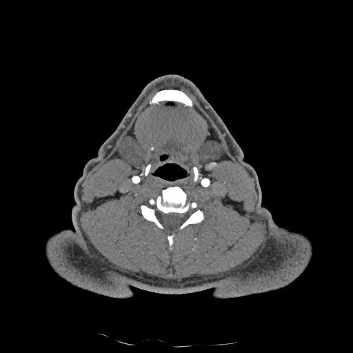 Buccal fat pad arteriovenous malformation (Radiopaedia 70936-81144 D 130).jpg