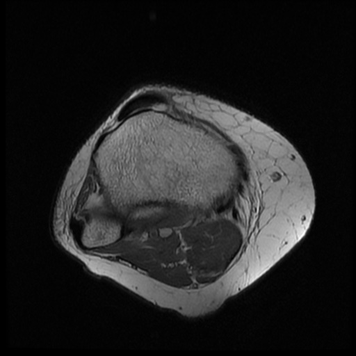 File:Bucket handle meniscus tear (Radiopaedia 56916-63751 Axial PD 18).jpg