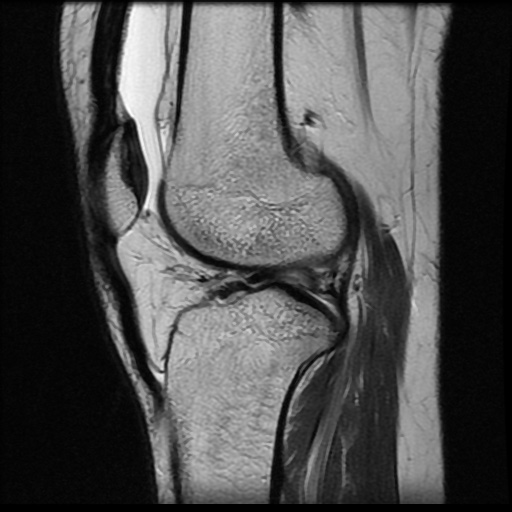 File:Bucket handle meniscus tear (Radiopaedia 56916-63751 Sagittal T2 8).jpg