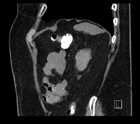 Buried bumper syndrome - gastrostomy tube (Radiopaedia 63843-72577 Sagittal Inject 22).jpg