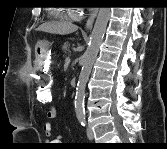 Buried bumper syndrome - gastrostomy tube (Radiopaedia 63843-72577 Sagittal Inject 58).jpg