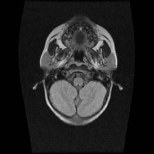 File:Burkitt lymphoma of the orbit- pre and post chemotherapy (Radiopaedia 31214-31930 Axial FLAIR 3).jpg