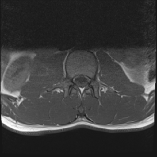 File:Burst fracture - T12 with conus compression (Radiopaedia 56825-63646 Axial T1 1).png
