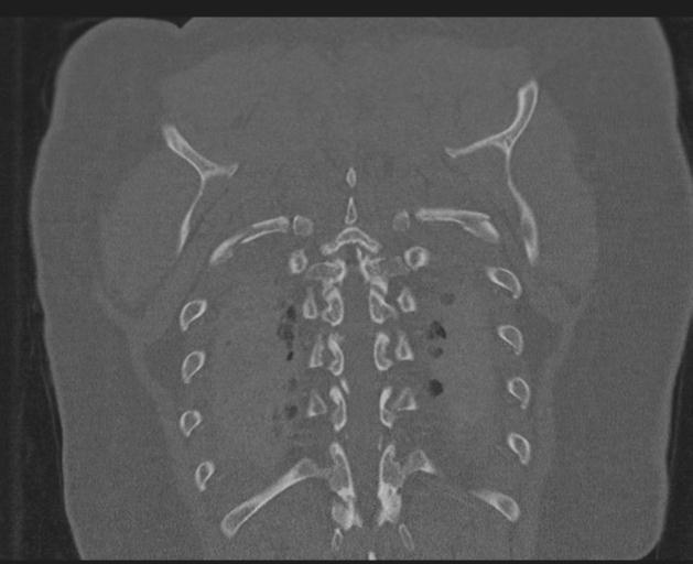 Burst fracture - thoracic spine (Radiopaedia 30238-30865 Coronal bone window 139).jpg