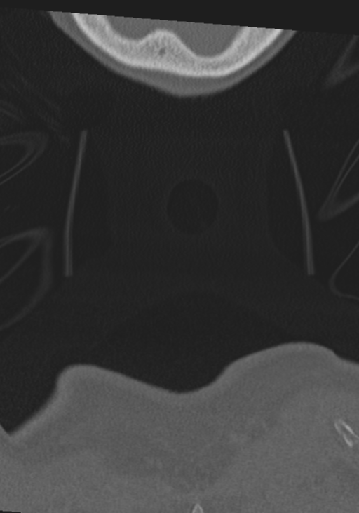 C2 fracture with vertebral artery dissection (Radiopaedia 37378-39199 Coronal bone window 77).png