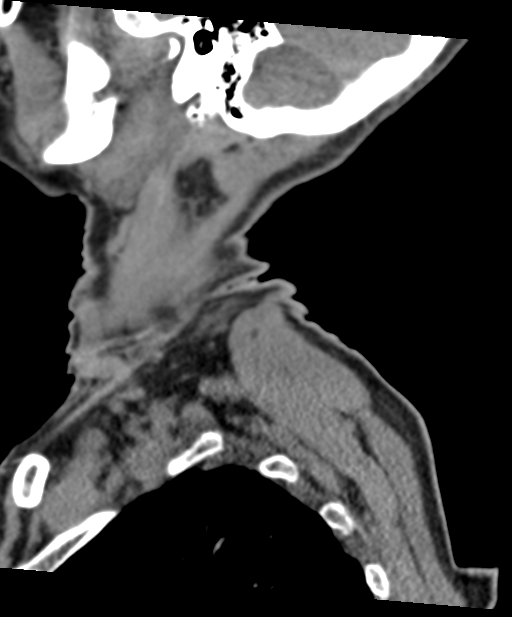 C2 fracture with vertebral artery dissection (Radiopaedia 37378-39199 D 72).png