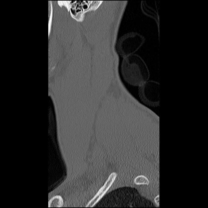 C5 facet fracture (Radiopaedia 58374-65499 Sagittal bone window 64).jpg
