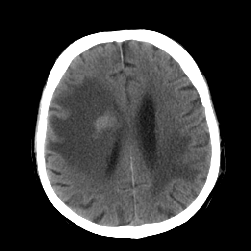 File:CNS lymphoma (Radiopaedia 36983-38639 Axial non-contrast 25).png