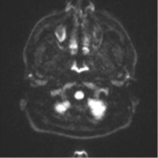 File:CNS vasculitis (Radiopaedia 55715-62263 Axial DWI 31).png