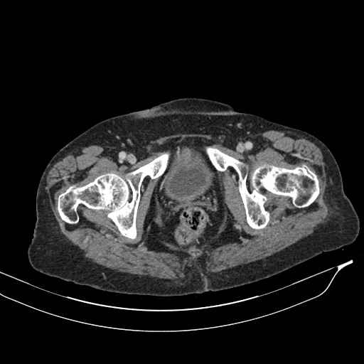 Calcified adrenal glands and Spigelian hernia (Radiopaedia 49741-54988 A 240).jpg