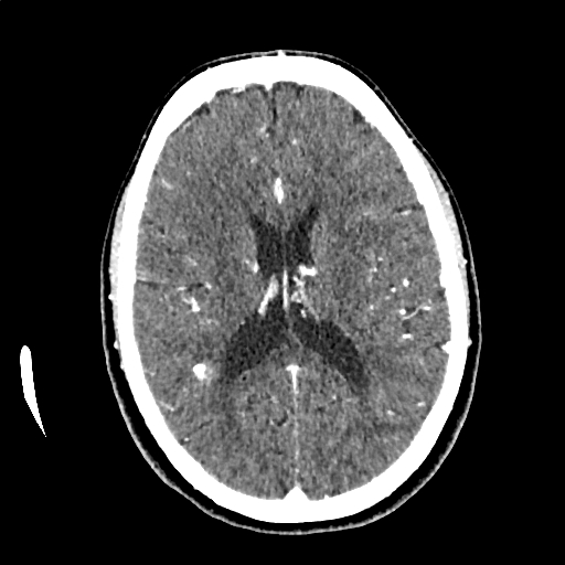 Calcified cerebral hydatid cyst (Radiopaedia 65603-74717 Axial with contrast 45).jpg
