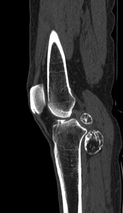 Calcified hematoma - popliteal fossa (Radiopaedia 63938-72763 Sagittal bone window 30).jpg
