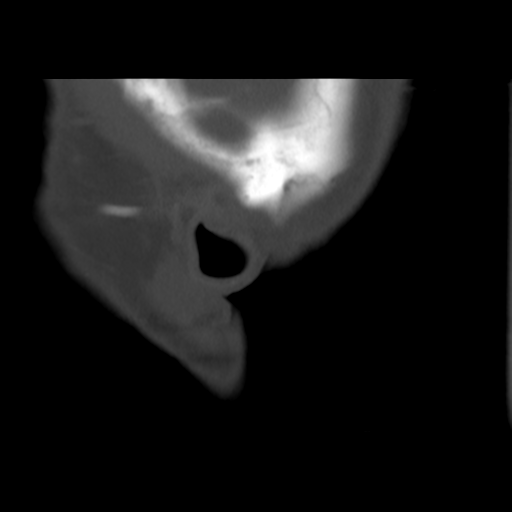 Calcifying pseudoneoplasm of neuraxis (Radiopaedia 44076-47617 D 6).png