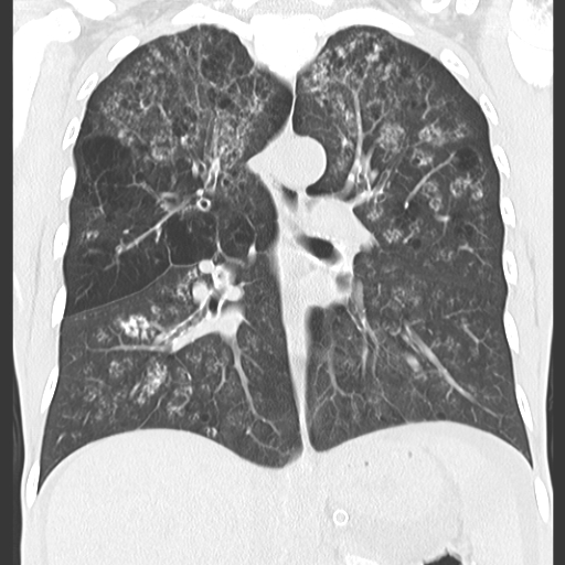 File:Calciphylaxis and metastatic pulmonary calcification (Radiopaedia 10887-11317 C 5).jpg
