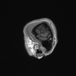 Callosal dysgenesis with interhemispheric cyst (Radiopaedia 53355-59335 Sagittal T1 15).jpg