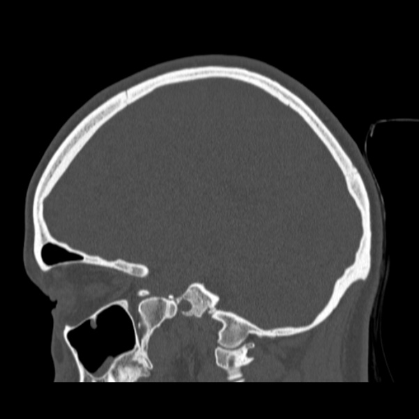 Calvarial osteoma (Radiopaedia 36520-38079 Sagittal bone window 68).jpg