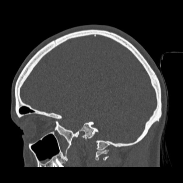 Calvarial osteoma (Radiopaedia 36520-38079 Sagittal bone window 70).jpg