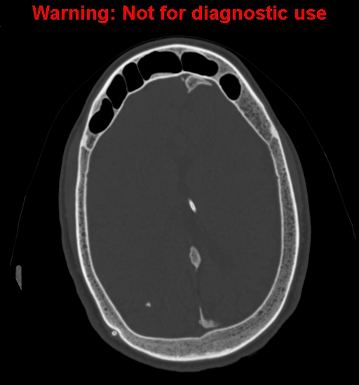 Calvarial thickening from chronic shunting (Radiopaedia 60079-67637 Axial bone window 117).jpg