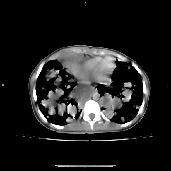 File:Cannon ball metastases - synovial sarcoma (Radiopaedia 26135-26271 C 27).jpg