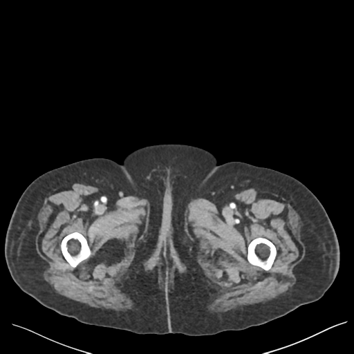 Cannonball metastases from endometrial cancer (Radiopaedia 42003-45031 E 85).png