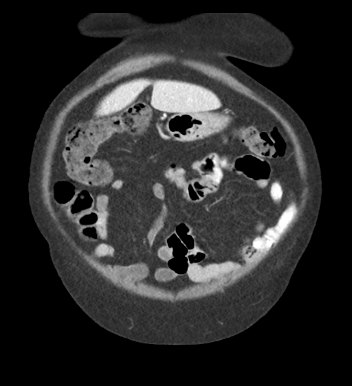 Cannonball metastases from endometrial cancer (Radiopaedia 42003-45031 F 15).png