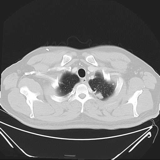 File:Cannonball pulmonary metastases (Radiopaedia 67684-77101 Axial lung window 2).jpg