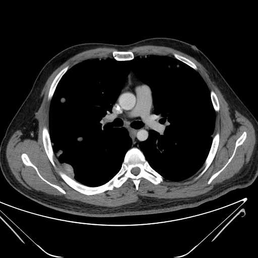 File:Cannonball pulmonary metastases (Radiopaedia 67684-77101 D 119).jpg