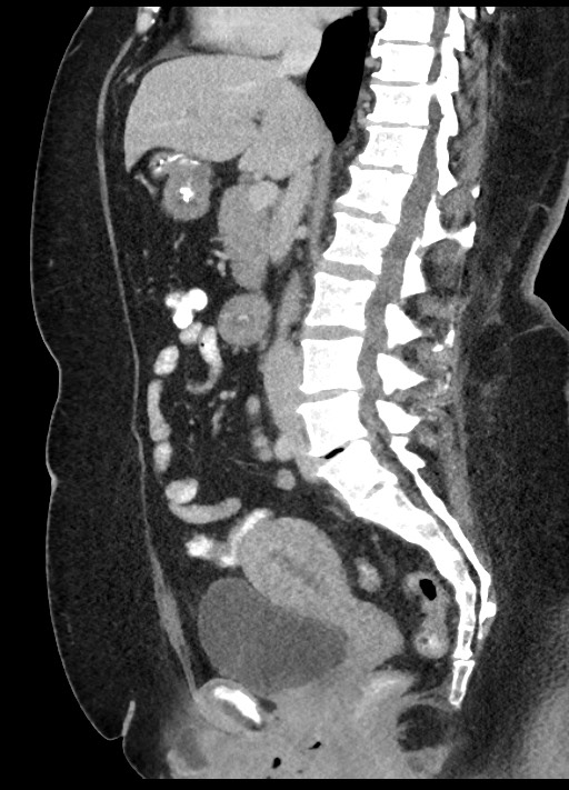 Carcinoid tumor - terminal ileum (Radiopaedia 60931-68739 C 50).jpg
