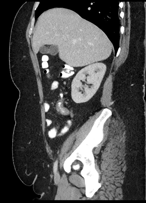 Carcinoid tumor - terminal ileum (Radiopaedia 60931-68739 C 73).jpg