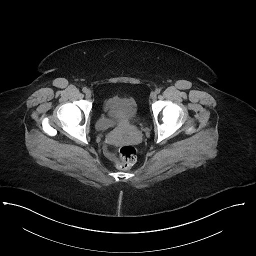 Carcinoid tumor - terminal ileum (Radiopaedia 60931-68740 Axial non-contrast 117).jpg
