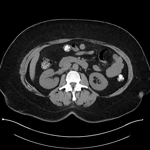 File:Carcinoid tumor - terminal ileum (Radiopaedia 60931-68740 Axial non-contrast 49).jpg